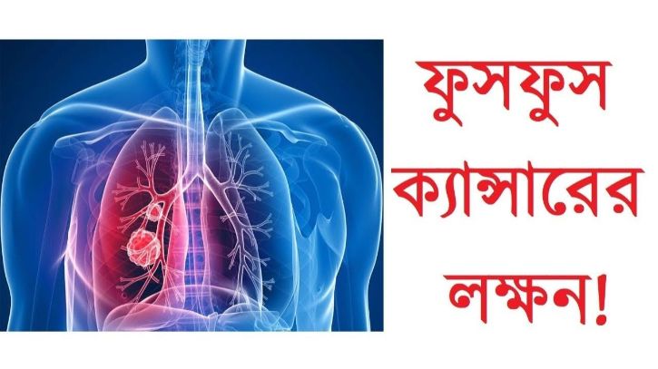 ফুসফুসের ক্যান্সারের লক্ষণ চেনার উপায়?