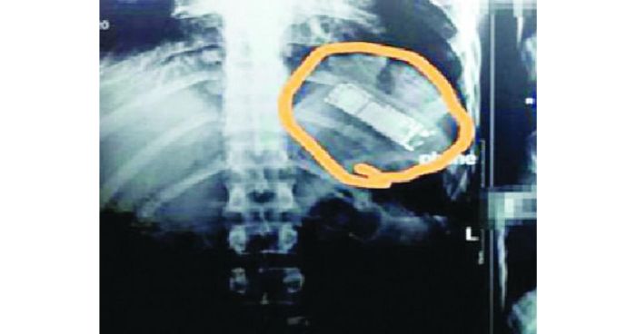 মোবাইল ফোন গিলে ফেললেন যুবক