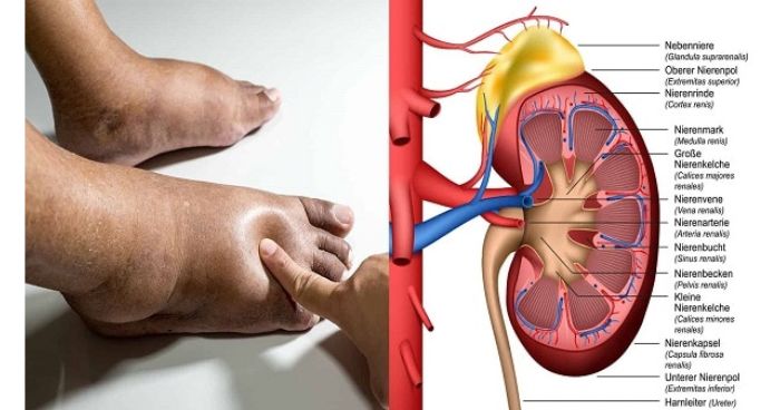 কিডনির রোগীরা কী খাবেন,আর কি খাবেন না?