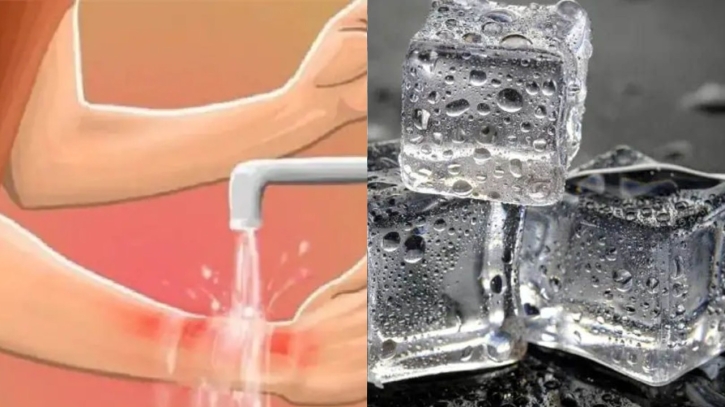 পোড়া স্থানে কেন বরফ দেওয়া উচিত নয়?