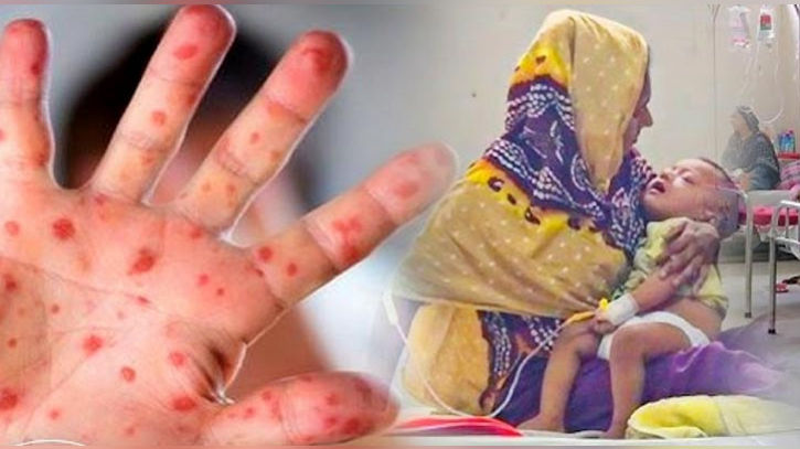২৪ ঘণ্টায় হাম ও হামের উপসর্গে সাত জনের মৃত্যু