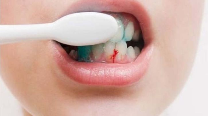 মাড়ি থেকে রক্ত পড়া বন্ধের ঘরোয়া তিন উপায়