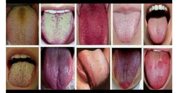 যেভাবে জিহ্বার রঙ দেখে রোগ চিনবেন ?